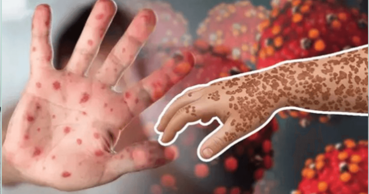 হামে মৃত্যু সংখ্যা প্রায় ১০০